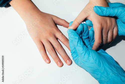 Children's hand with a wart on a white background. Papilomavirus. Top view