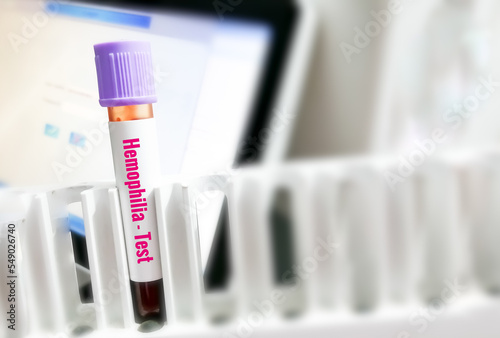 Fototapeta Naklejka Na Ścianę i Meble -  Blood sample for hemophilia test, inherited genetic disorder