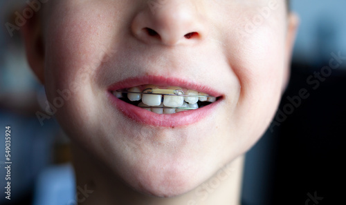 Orthodontist plates on children s teeth. Bite alignment. Orthodontic plate on the upper jaw. Children s tooth.