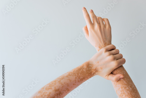 cropped view of woman with vitiligo chronical skin condition on hands isolated on grey.