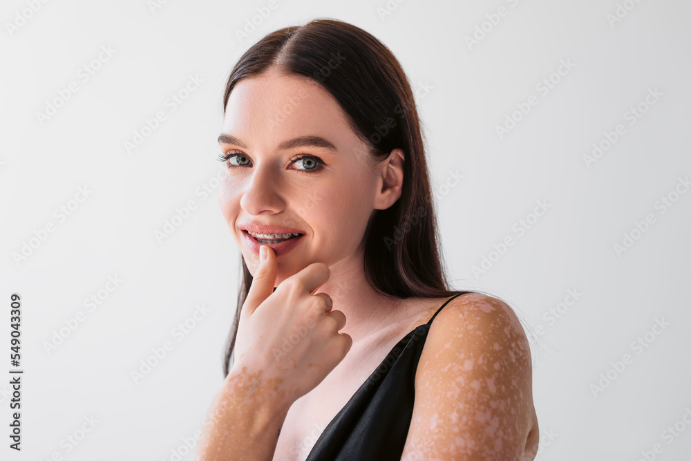 Portrait of pretty woman with vitiligo touching lip and smiling at camera isolated on grey. Portrait of pretty woman with vitiligo touching lip and smiling at camera isolated on grey.