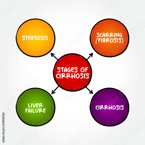 Stages of cirrhosis (scarring of the liver caused by long-term liver damage) mind map text concept for presentations and reports