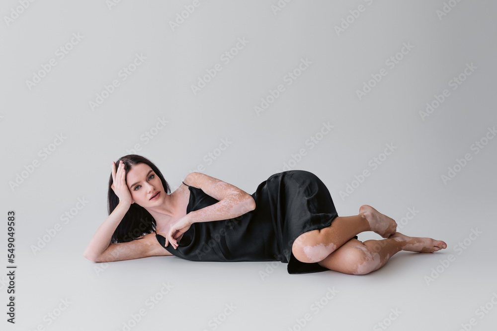 Pretty and barefoot woman with vitiligo lying on grey background.