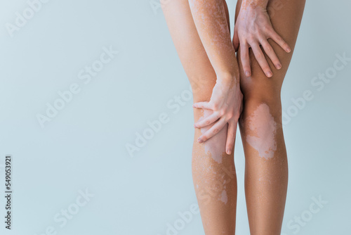 cropped view of model with vitiligo chronical skin condition posing isolated on grey.