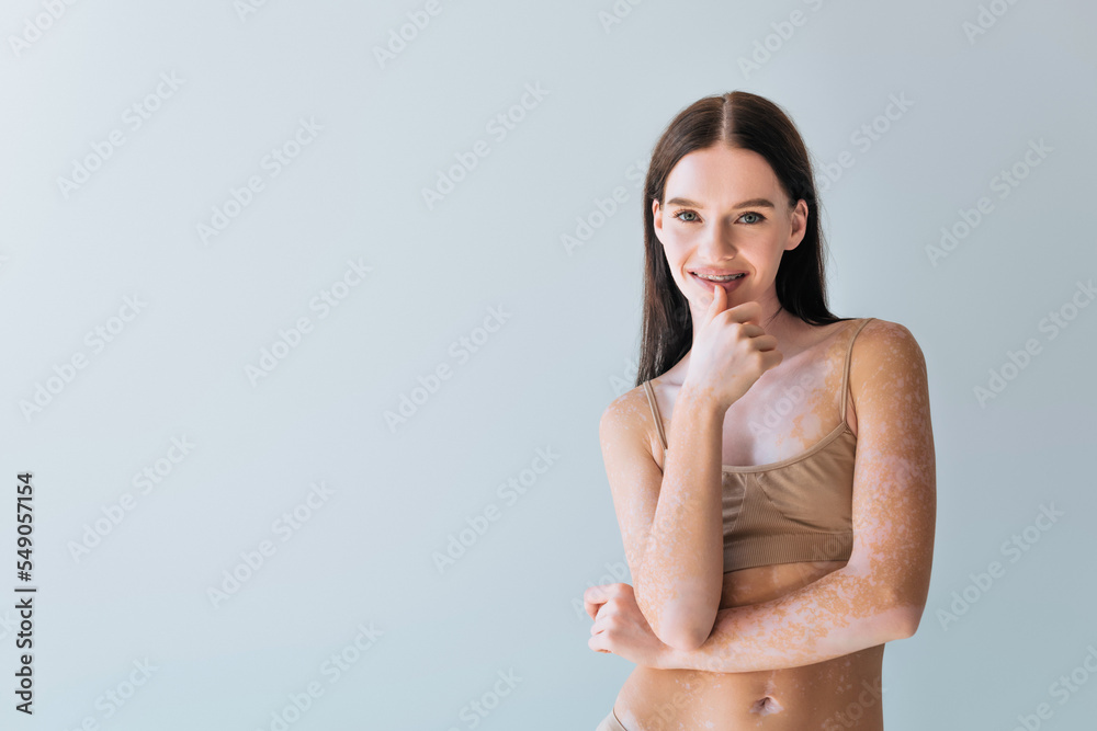 Fototapeta premium joyful young woman with vitiligo and braces smiling isolated on grey.