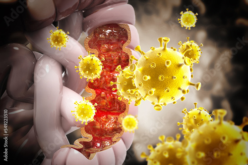 Colon cancer, Viral infection, Colon disease concept.  3d illustration photo