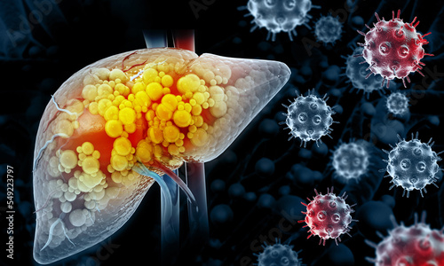 Liver cancer or liver tumor, Hepatocellular carcinoma (HCC), causes, symptoms, treatments, 3d illustration photo