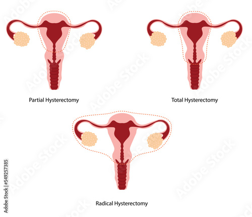 Hysteroscopy surgery type. Diferent types of uterus removal. Gynecology surgeries.