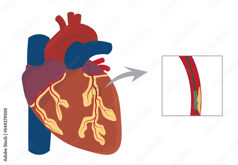 Cardiac Catheterization illustration. Illustration of a catheterization