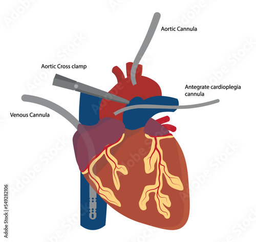 Cannulated Heart for a open chest cardiac surgery. Cardiopumonary bypass system cannula positioned photo