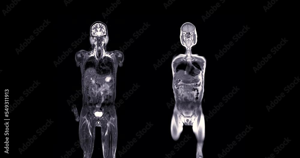 MRI whole body scan Coronal T2 and T1 by MRI scanner.