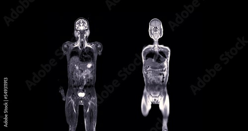 MRI whole body scan Coronal T2 and T1 by MRI scanner.