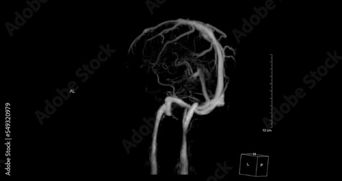 MR cerebral venography (MRV) or MRV Brain for diagnostic Cerebral venous thrombosis (blood clots in the brain) and 
Structural vein abnormalities. photo