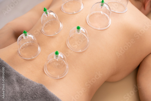 Woman's back with vacuum jars at a massage session.