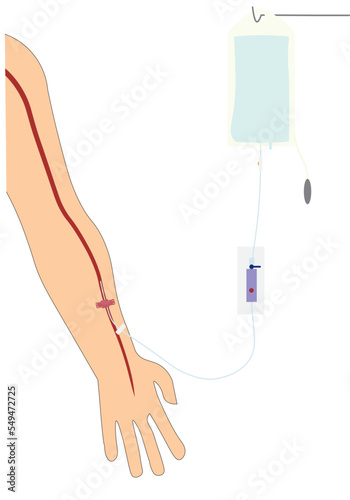 Arterial Line. Invasive arterial blood monitoring system. Hand with an arterial line conected with a pressure bag and the monitor showing the curves. Hemodynamic monitoring