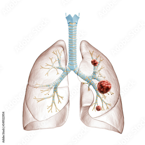 Lung cancer or carcinoma 3D rendering illustration. Bronchial tree and lungs infected by cancer cells on white background. Medical, healthcare, oncology, disease, science concept. photo