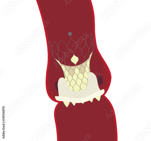 Valve-in-valve transcatheter aortic valve replacement (ViV TAVR). Heart valve positioned by TAVI in a existing open surgery to change valve