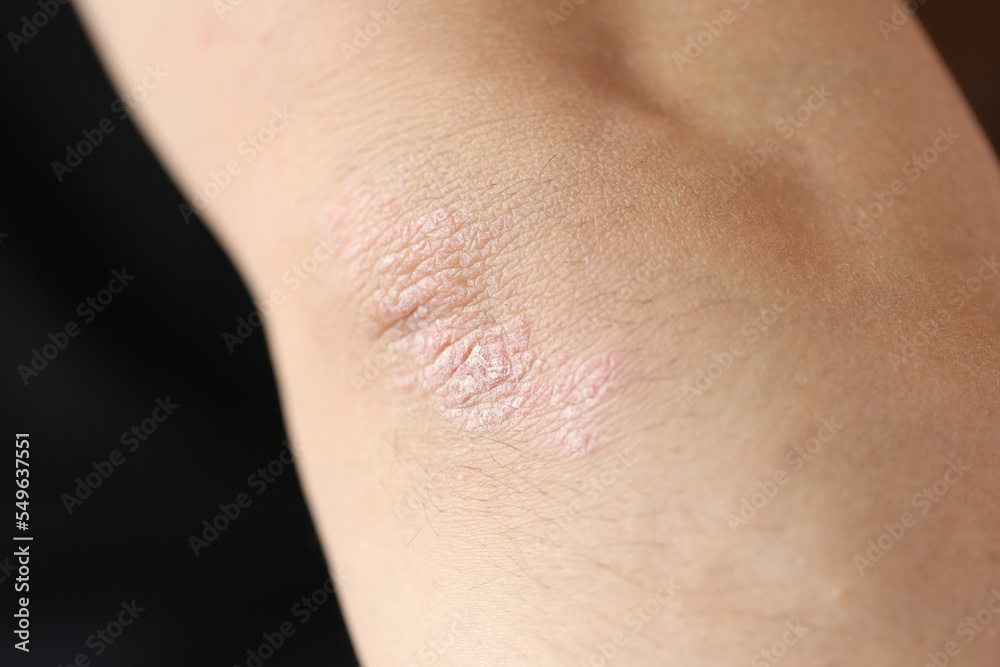 Psoriatic plaques on elbow of patient with skin disease closeup Psoriatic plaques on elbow of patient with skin disease closeup