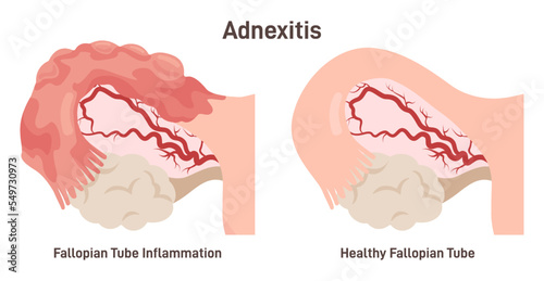 Salpingitis or adnexitis. Infection and inflammation in the fallopian tube