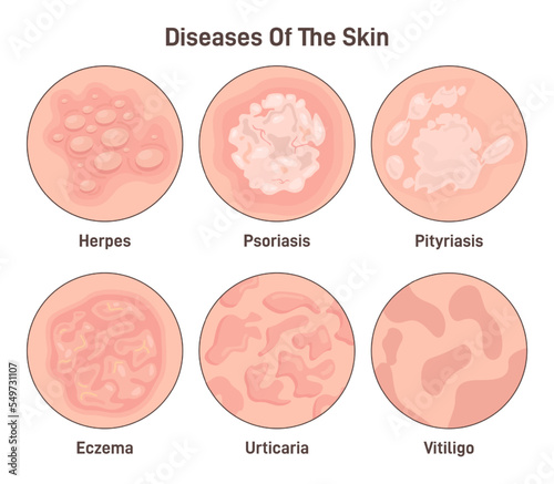 Skin diseases set. Derma infection, eczema and psoriasis. Dermatology