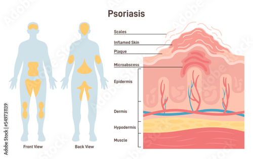 Psoriasis. Autoimmune disease characterized by areas of inflamed skin