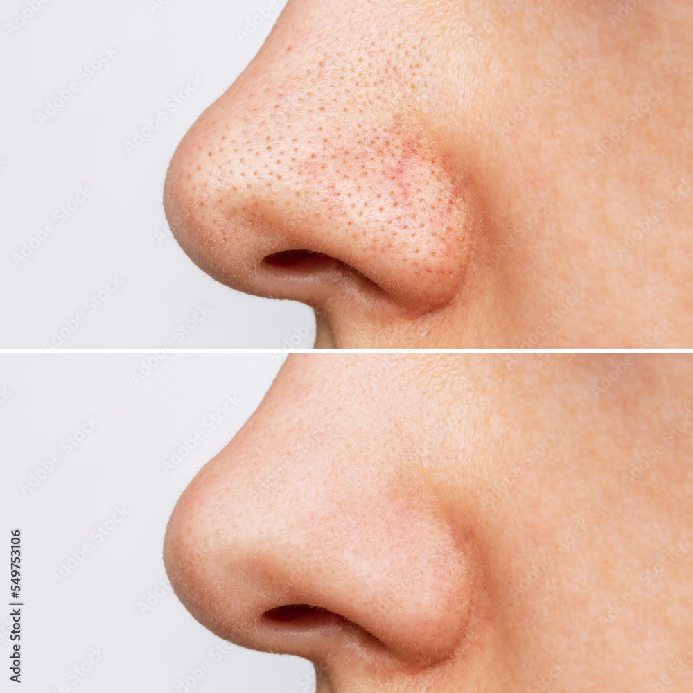 Profile of woman's nose with blackheads before and after peeling and cleansing the face. Acne problem, comedones. Getting rid of black dots. Cosmetology dermatology concept. Skin care Profile of woman's nose with blackheads before and after peeling and cleansing the face. Acne problem, comedones. Getting rid of black dots. Cosmetology dermatology concept. Skin care