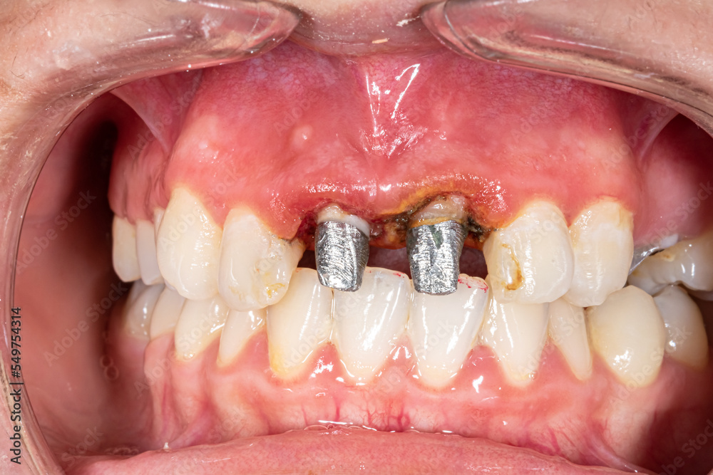 Front view of maxillary central incisors metal build-up with metallic post and core fixed prosthesis for a crown reconstitution. Cheeks and lips retracted and bloody inflammatory gingival gum.