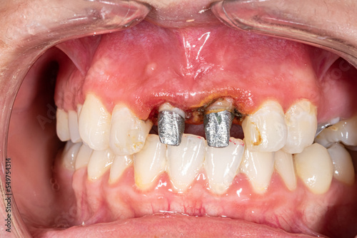 Front view of maxillary central incisors metal build-up with metallic post and core fixed prosthesis for a crown reconstitution. Cheeks and lips retracted and bloody inflammatory gingival gum.