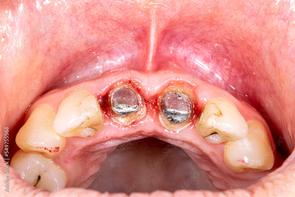 Occlusal view of maxillary central incisors metal buildup with