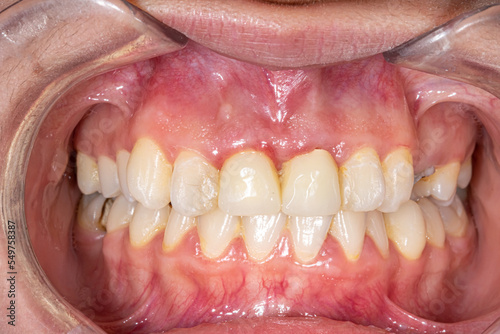 Frontal view of occlusion teeth, arches with gum inflammatory and fixed prosthetic crowns in central incisors. Cheeks and lips retracted with transparent plastic cheek retractor