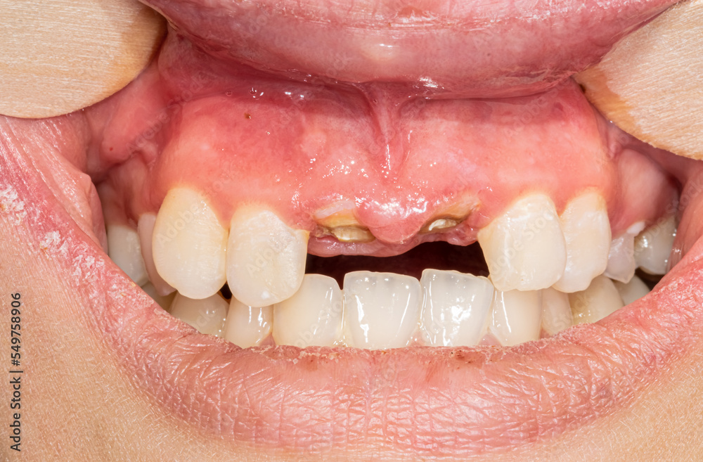 Front view of decayed broken central incisors causing an aesthetical condition with roots and inflammatory gingiva gum in dental occlusion. Cheeks and lips retracted with wooden tongue depressors. 