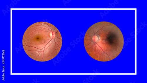 Slika na platnu View inside human eye disorders - showing retina, optic nerve and macula