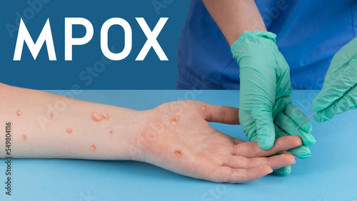 Doctor in medical gloves holds a syringe. Medical worker making a vaccine to a patient. Take blood from a finger with a large needle. Mpox infection concept. photo