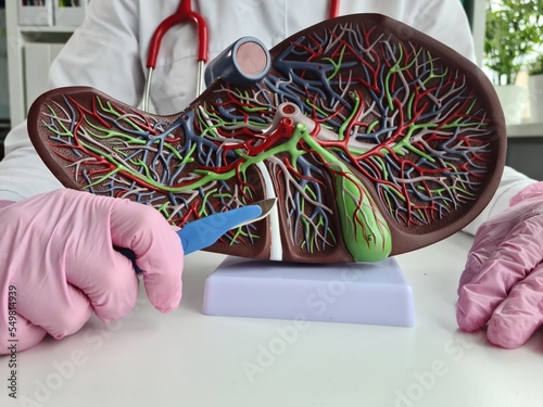 Human liver model fibrous cirrhotic and cancerous photo