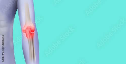 Elbow pain, joint pain, bad epicondyle, elbow arthritis, fracture. Medical care and treatment, modern medicine. Elbow pain isolated on emerald green background photo