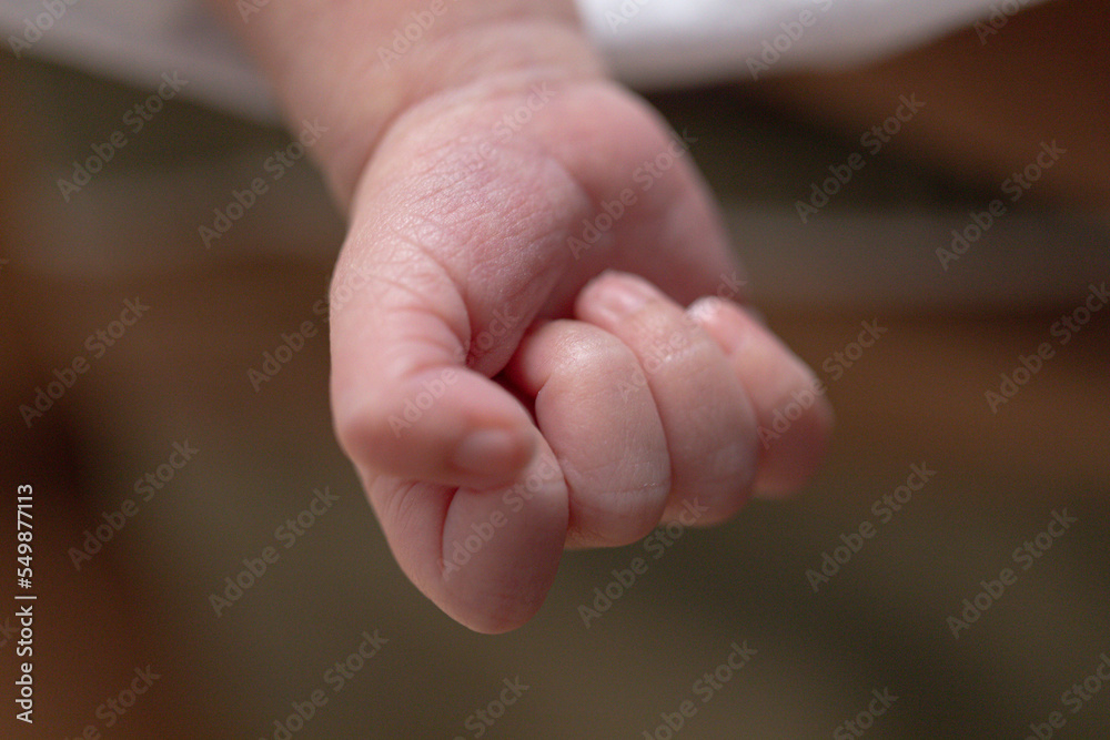It is a dermatitis small warty bumps appear on the skin in child. It is a dermatitis small warty bumps appear on the skin in child.