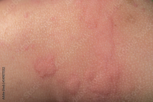 It is a dermatitis small warty bumps appear on the skin in child.