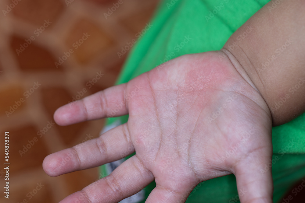 It is a dermatitis small warty bumps appear on the skin in child. Stock Photo Adobe Stock
