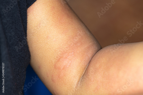 It is a dermatitis small warty bumps appear on the skin in child.