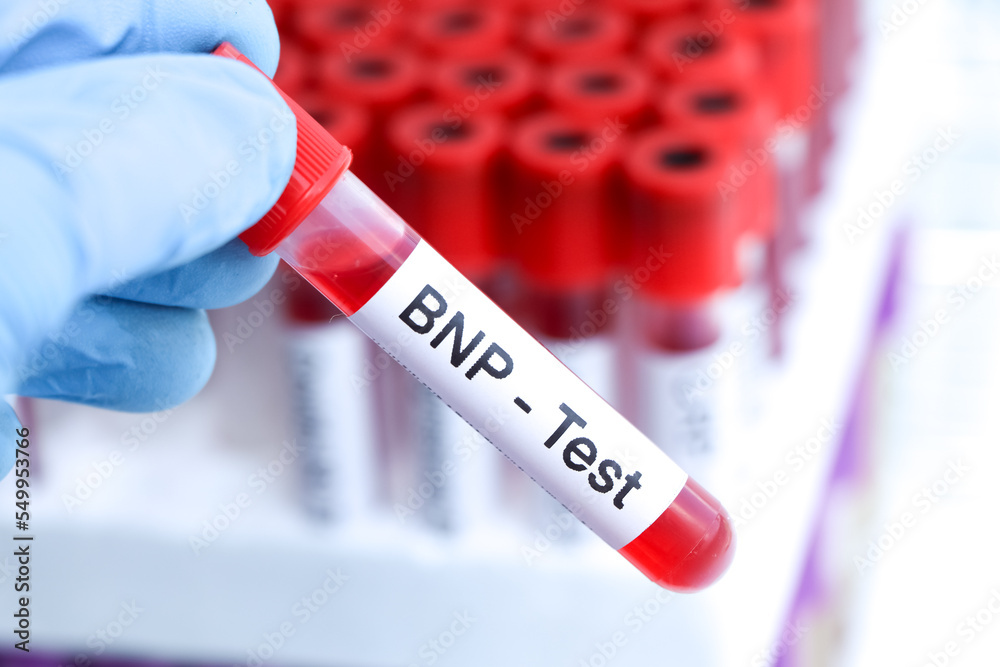 Obraz premium BNP test to look for abnormalities from blood