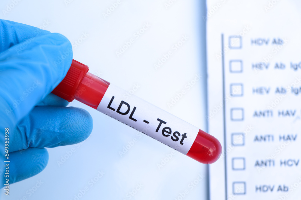 Obraz premium LDL test to look for abnormalities from blood