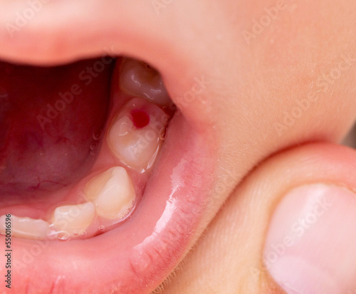 Installation of a colored red filling in a milk tooth for a child. Colored fillings in dentistry for children. Treatment of pulpitis and deep caries, close-up