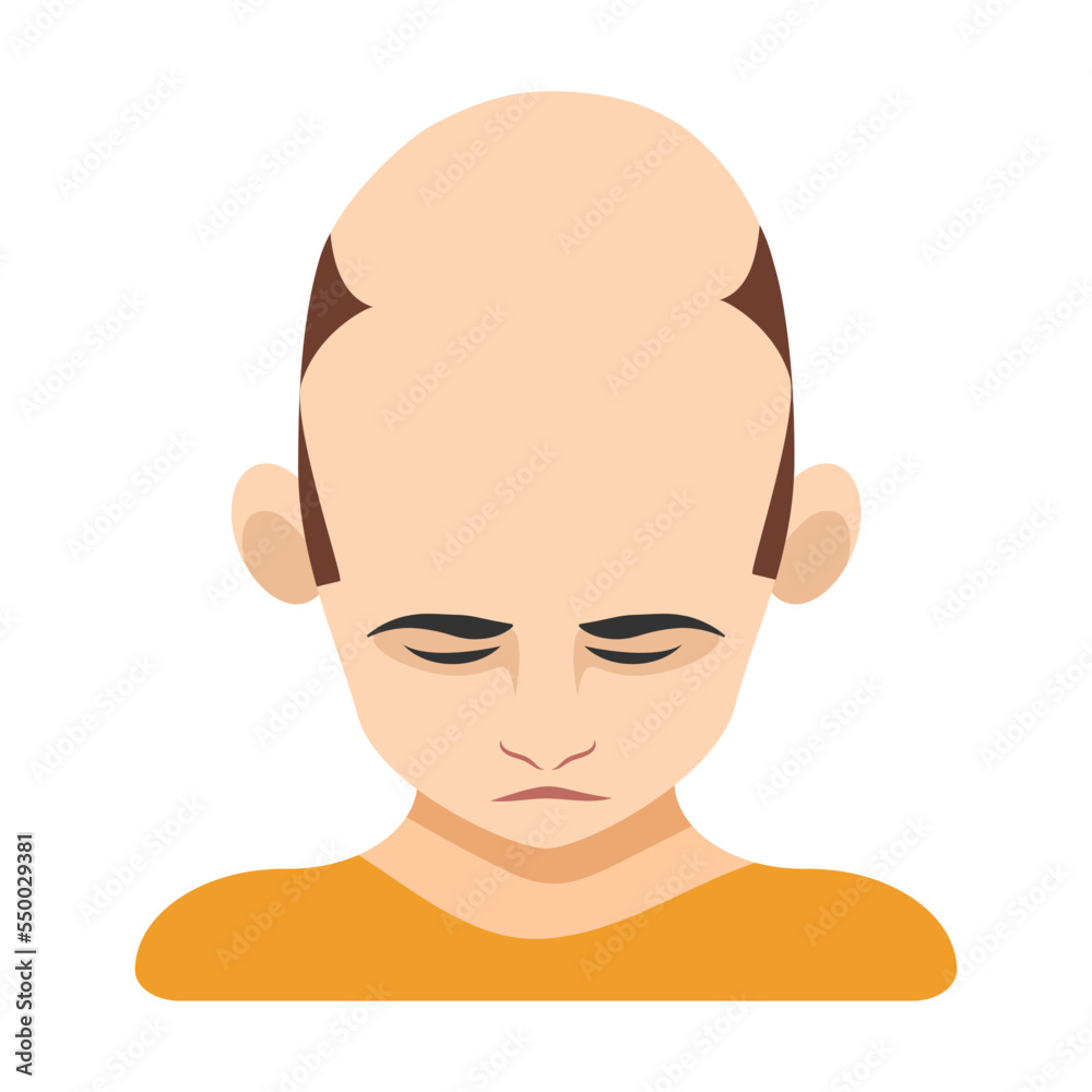Severe baldness, alopecia in men vector illustration. Top of male head