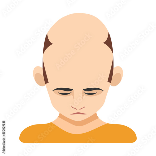 Severe baldness, alopecia in men vector illustration. Top of male head with bald spot on scalp isolated on white background. Health, hair loss or treatment concept