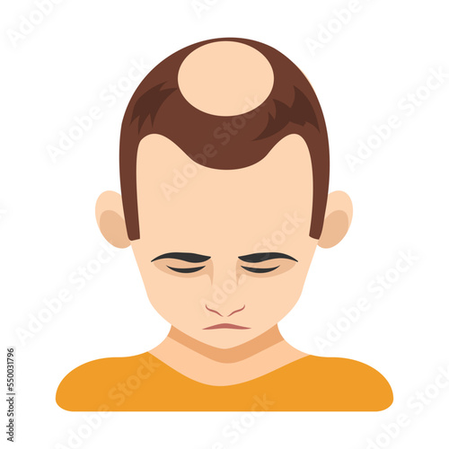 Third stage of alopecia in men vector illustration. Top of male head with bald spot on scalp isolated on white background. Health, hair loss or treatment concept