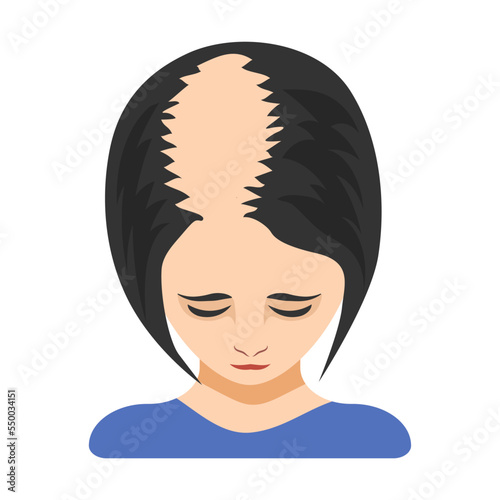Third stage of alopecia in women vector illustration. Top of female head with bald spot on scalp isolated on white background. Health, hair loss or treatment