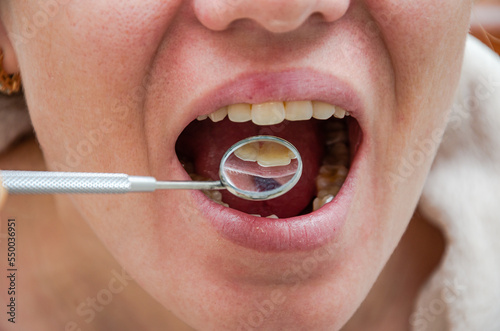 Dentist examining patient s teeth with a dental mirror  