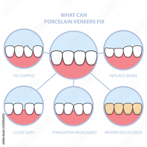 Teeth and smile makeover with dental ceramic veneers, row of teeth fixed with veneer cover, before and after teeth, vector