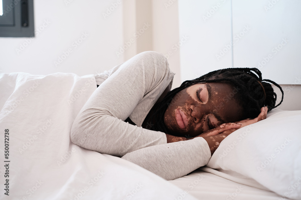 Black woman with while pigmentation on skin sleeping in light bedroom Black woman with while pigmentation on skin sleeping in light bedroom