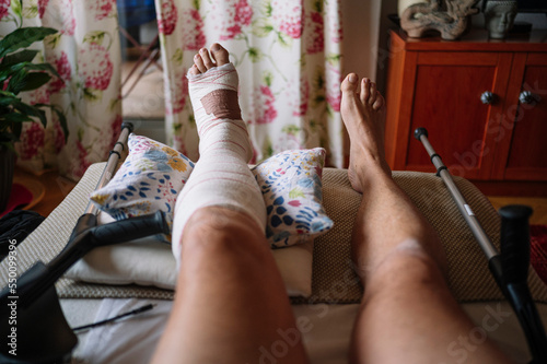 Fractured foot with a bandage made by a doctor.